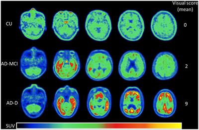 Visual reading for [18F]Florzolotau ([18F]APN-1607) tau PET imaging in clinical assessment of Alzheimer’s disease